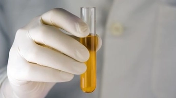 İdrar Dansitesi Belirtileri ve Tedavisi