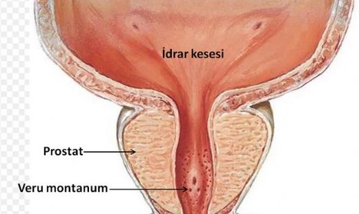 İdrar Kanseri Belirtileri ve Tedavisi