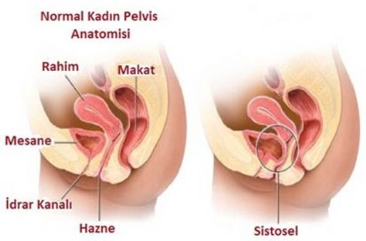 İdrar Kesesi Sarkması Belirtileri ve Tedavisi