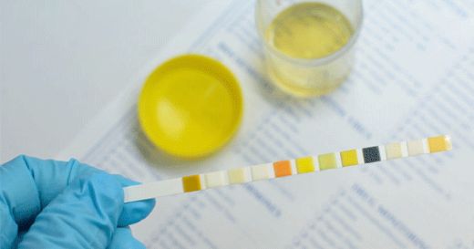 İdrar Tahlilinde Epitel Belirtileri ve Tedavisi