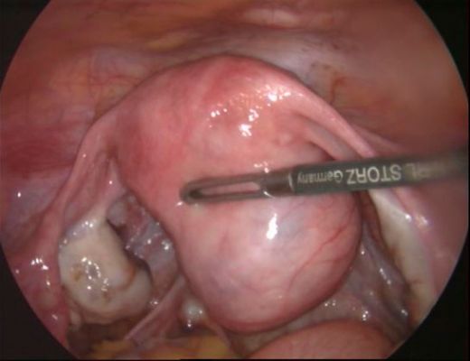 İdrar Torbası Ameliyatı Riskleri ve Sonrası