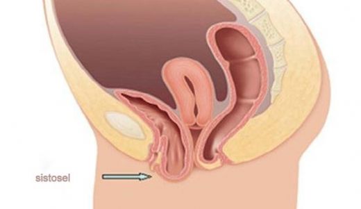 İdrar Torbası Sarkması Belirtileri ve Tedavisi