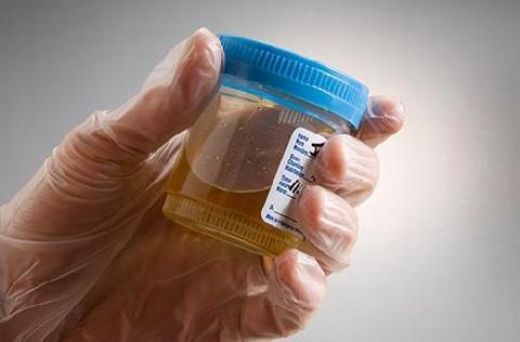 İdrarda Keton Pozitif Olması Nedenleri?