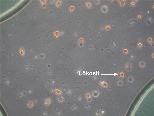İdrarda Lökosit Bulunmasının Nedenleri