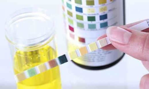 İdrarda Protein Belirtileri ve Tedavisi