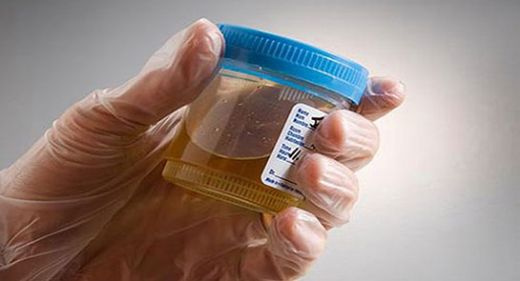 İdrarda Sperm Olması