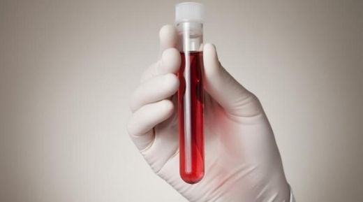 İdrarda Üre Yüksekliği ve Düşüklüğü