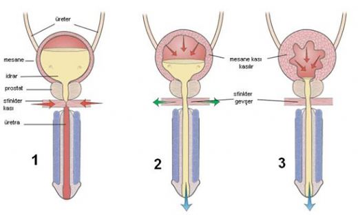 Tuvaletten Sonra Mesanede İdrar Kalması Nedenleri?
